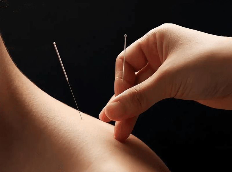 acupuncture