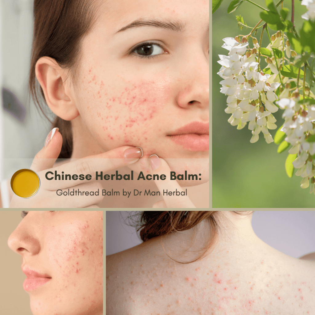 Natural Chinese Herbal Acne Balm